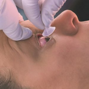 Eye Irrigation System Morgan   Lens 6 Inch Tubing Under Eyelid