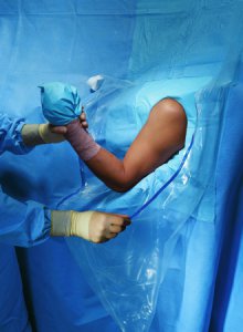 Orthopedic Drape Shoulder Arthroscopy Drape 160 W X 102 L Inch Sterile