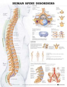 Anatomical Chart Human Spine Disorders 20 X 26 Inch Plastic Wall Mount Laminated