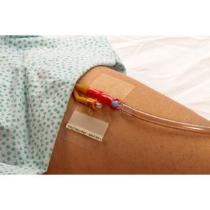 Catheter Holder Hold-n-Place   One Size Fits All, Adhesive Patch
