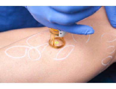 Skin Marker EZ Removable Ink    White Regular Tip NonSterile