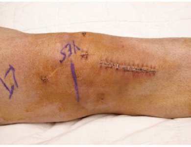 Surgical Skin Marker Purple Fine / Regular Tip NonSterile